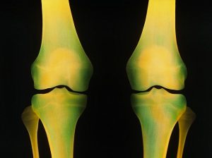 Orthotics Knee Pain